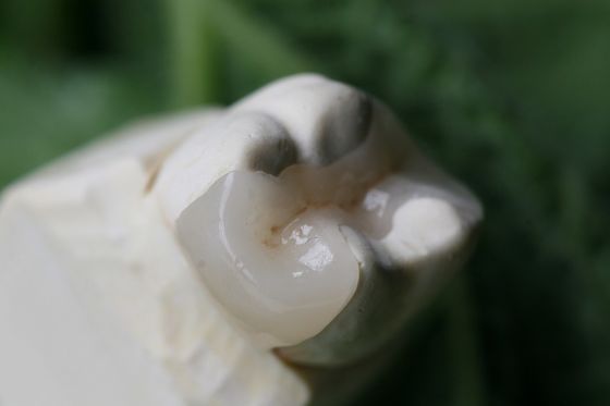 Trám phủ và khảm mão răng EMAX nhân tạo thẩm mỹ