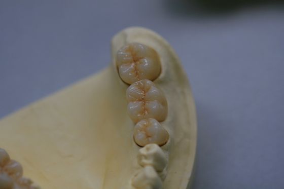 Phòng thí nghiệm nha khoa Zirconium Oxide Sứ Zirconia Nha khoa Bọc răng bằng sứ