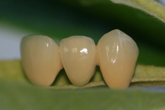 Phòng thí nghiệm thiết kế nha khoa Toàn sứ ISO13485 Vương miện nha khoa Zirconia cho răng trước