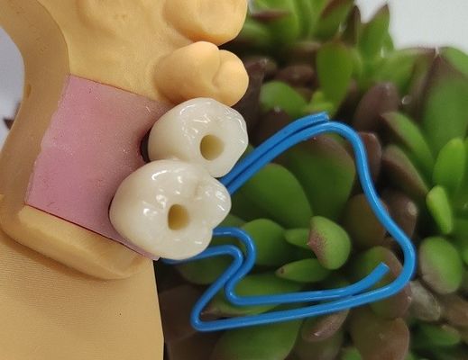 Vương miện cấy ghép nha khoa Endosseous