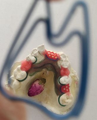 Khung kim loại cho răng giả một phần Cr Co