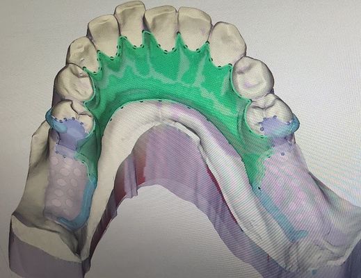 Khung kim loại hàm răng giả in một phần 3D có thể tháo rời