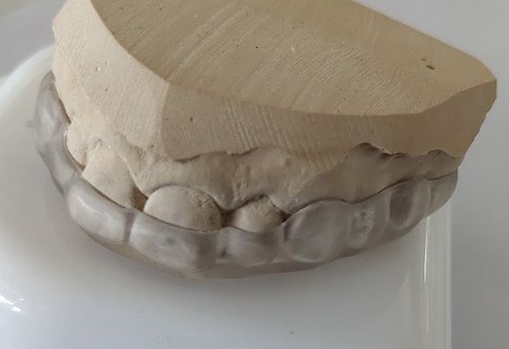 Tính thẩm mỹ Miệng vòm miệng dưới để nghiến răng