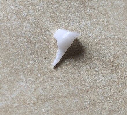 Gia cố lõi ghim răng sứ EMAX