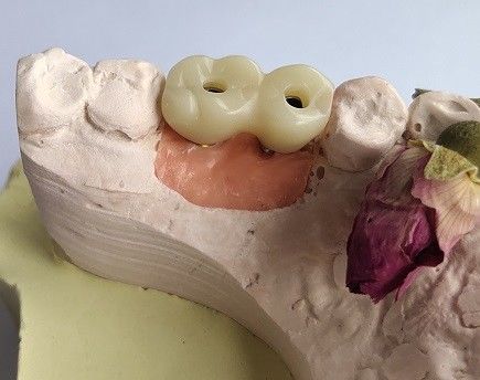 Vương miện tạm thời PMMA