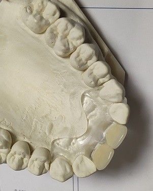 Phù hợp thoải mái ISO13485 RPD Răng giả vô hình mềm