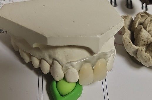 Hàm giả vô hình Valplast mềm và đàn hồi tạm thời
