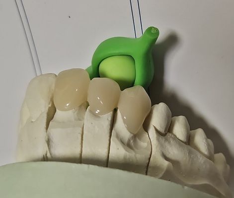 Vương miện tạm thời bằng kim loại composite lai PMMA