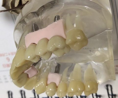 100% Tương thích sinh học PMMA Vương miện tạm thời
