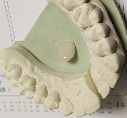 Nhựa tổng hợp màu tự nhiên Vương miện tạm thời cho răng trước