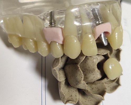 Phay trắng kim loại PFM trong nha khoa In 3D