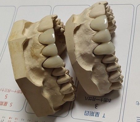 Bọc sứ CAD CAM PFM