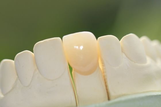 Bọc răng sứ thủy tinh vĩnh viễn tự nhiên cho răng trước