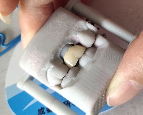 Phòng thí nghiệm PFM Vương miện nha khoa In 3D Cầu răng Vương miện