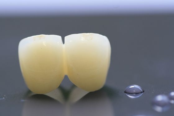 Khuôn khổ in 3D PFM Phòng thí nghiệm nha khoa Vương miện cho nha khoa