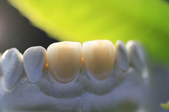 Khuôn khổ in 3D PFM Phòng thí nghiệm nha khoa Vương miện cho nha khoa