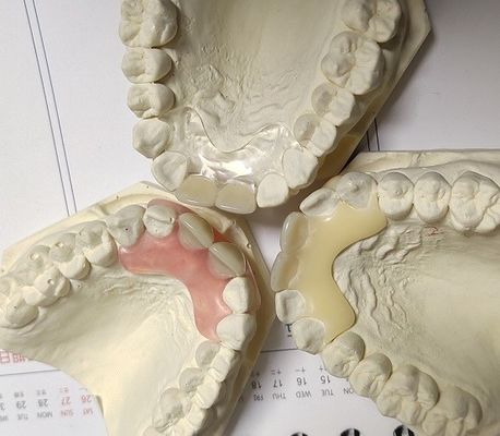 Resin Metal Free Invisable Denture cho bệnh nhân dị ứng